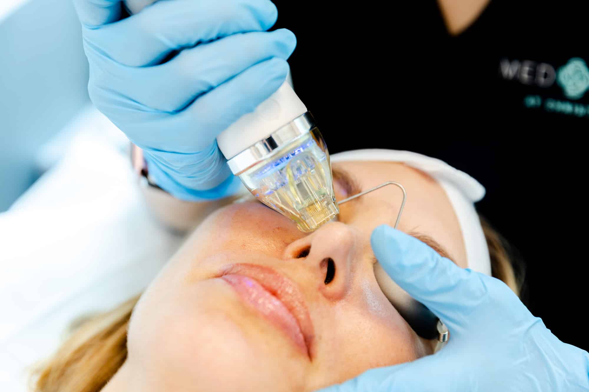 lovely woman receiving secret rf pro on her face for the best acne scar treatment in houston