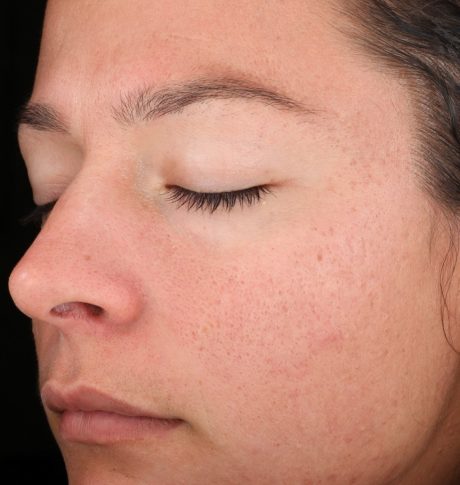 Chemical Peel