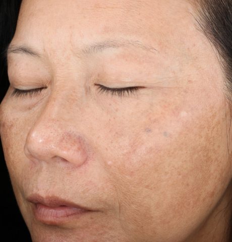 Chemical Peel