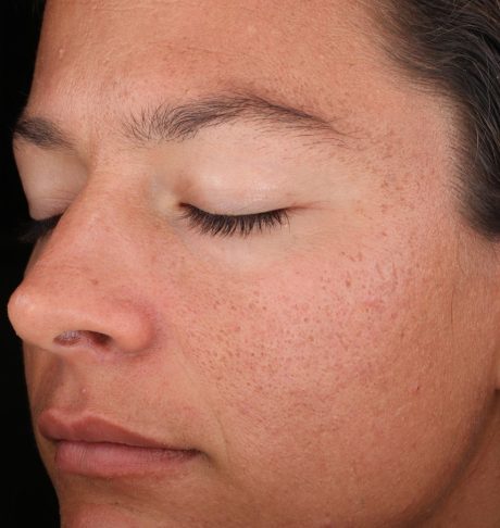 Chemical Peel