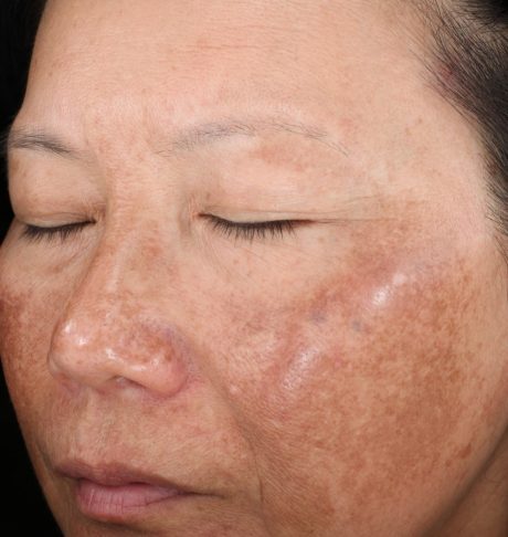 Chemical Peel