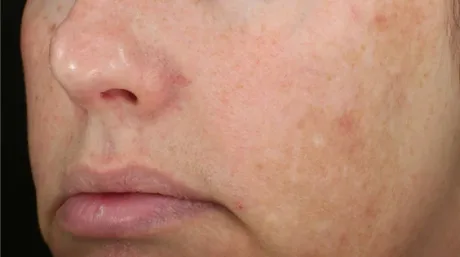 Diamond Glow - Dermal Infusion