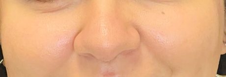 Diamond Glow - Dermal Infusion
