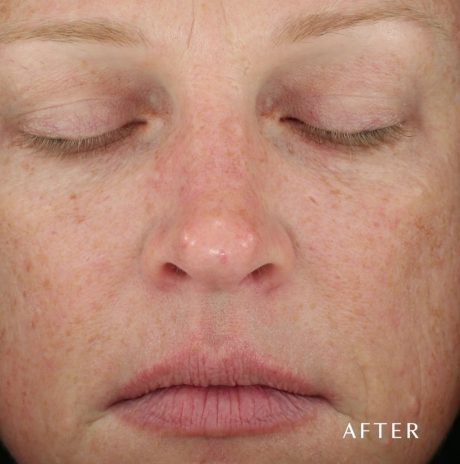 Diamond Glow - Dermal Infusion