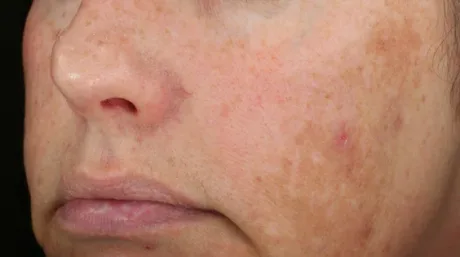 Diamond Glow - Dermal Infusion