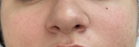 Diamond Glow - Dermal Infusion