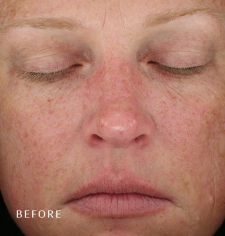 Diamond Glow - Dermal Infusion