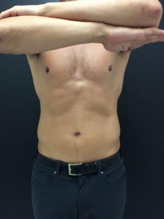 Emsculpt