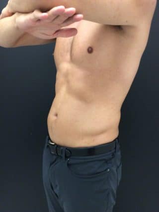 Emsculpt
