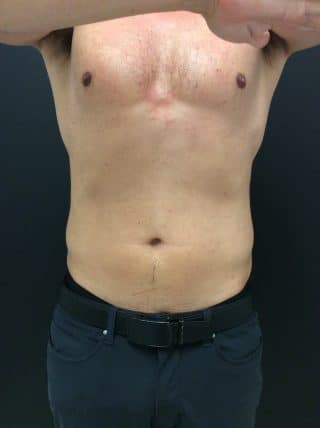 Emsculpt