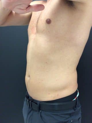 Emsculpt