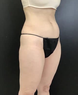 Emsculpt NEO