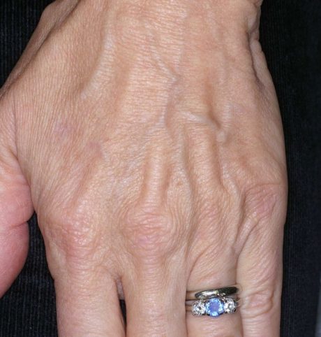 Hand Sunspot Removal - IPL