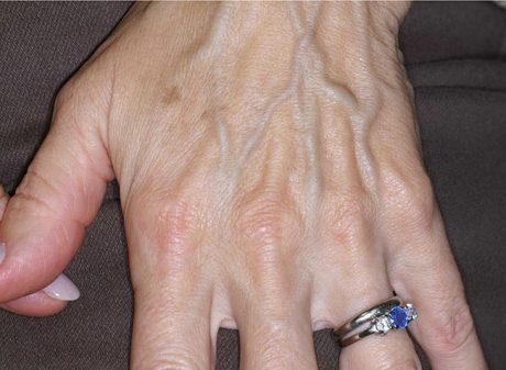 Hand Sunspot Removal - IPL