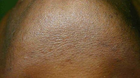 Laser Hair