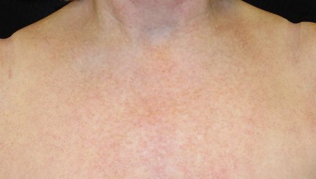 Photofacial - IPL