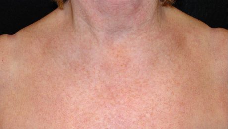 Photofacial - IPL