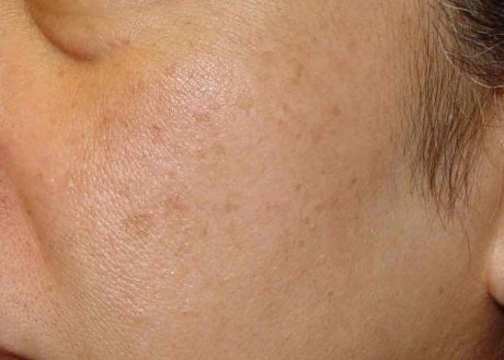Photofacial - IPL
