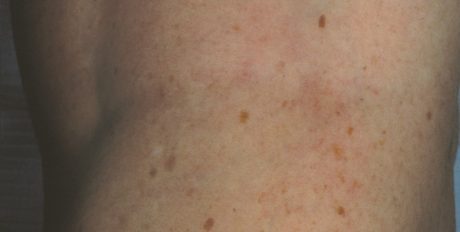 Spider Vein Laser Therapy