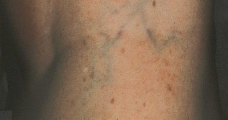 Spider Vein Laser Therapy