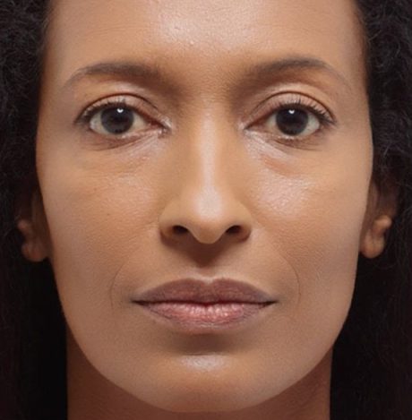 Before and after patient photo of Radiesse