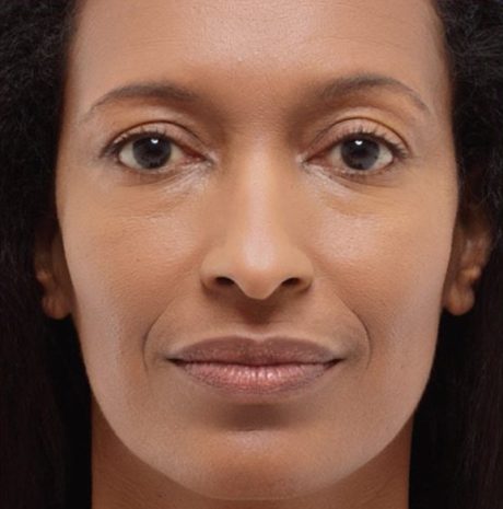 Before and after patient photo of Radiesse