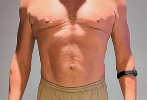 Emsculpt After