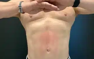 Emsculpt Before