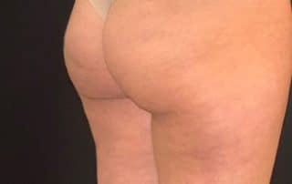 emsculpt after