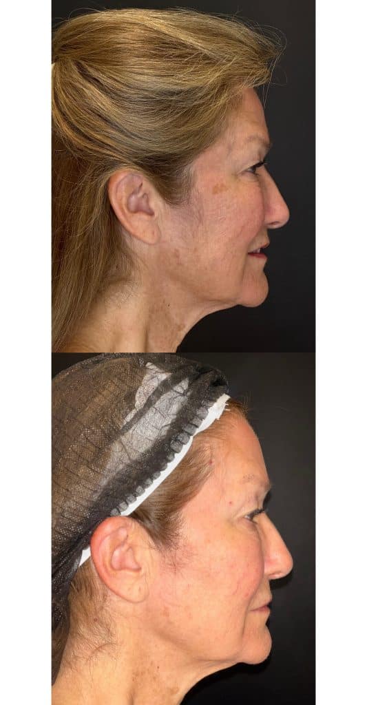 laser skin resurfacing houston