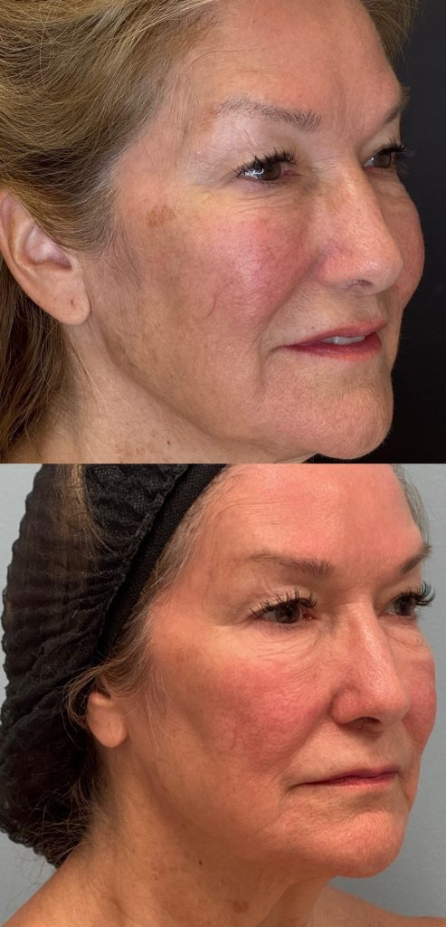 53a0a5da-6d3b-490d-9ece-08a83775589c laser skin resurfacing before and after