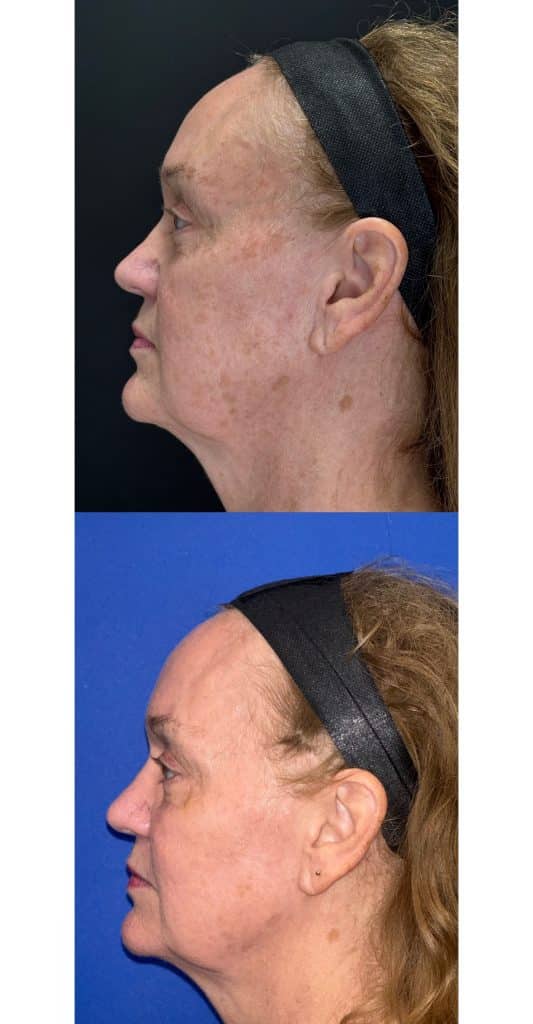 skin resurfacing katy tx