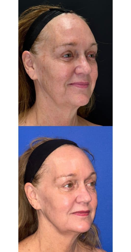 skin resurfacing houston