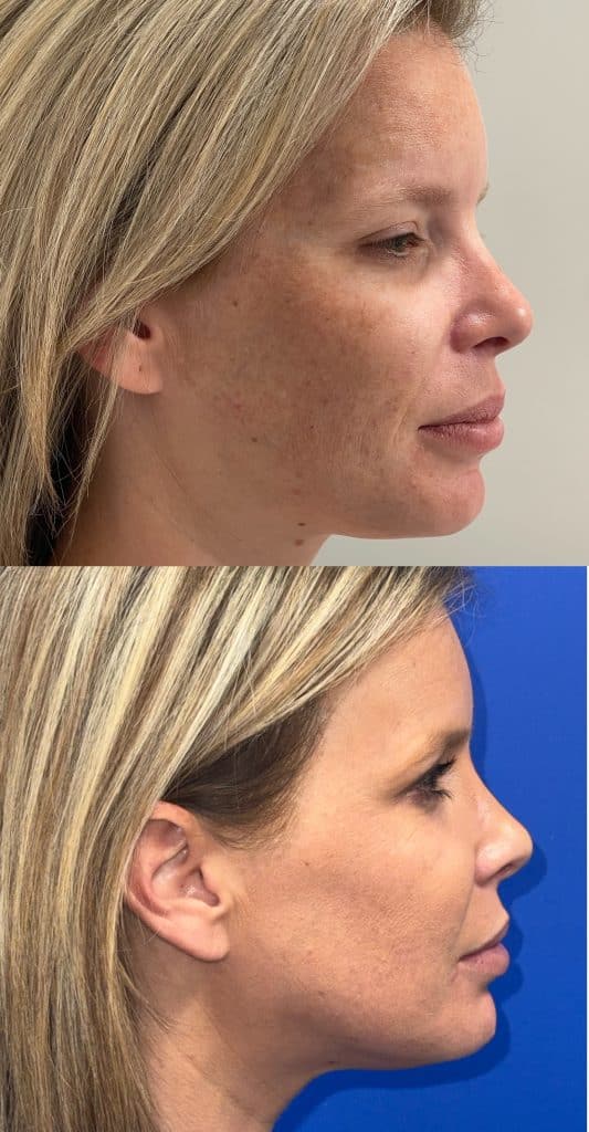 nouvaderm before and after houston
